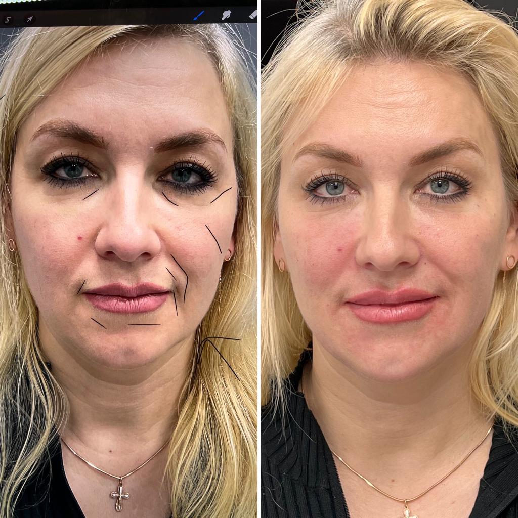 Full Face Rejuvenation: Transforming Beauty with Hyaluronic Acid Filler